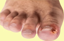 pain-free-ingrown-toenail-removal-by-expert-podiatrists-big-0