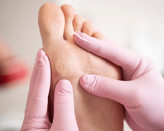 painful-corns-on-your-feet-get-expert-corn-removal-in-singapore