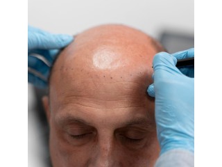 Best Fue Hair Transplant Clinic in Istanbul Turkey