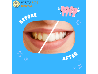 top-reasons-for-professional-zoom-whitening-small-0