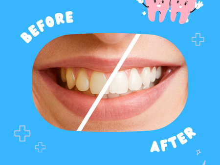 top-reasons-for-professional-zoom-whitening