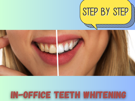 in-office-teeth-whitening-step-guide-big-0