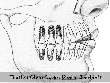 trusted-clear-choice-dental-implants-big-0