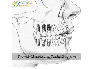 trusted-clear-choice-dental-implants-small-0