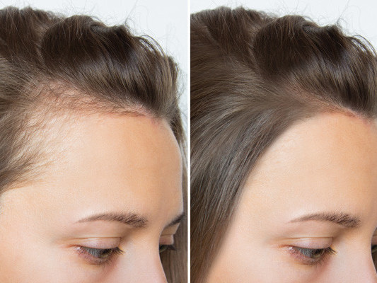 hairline-tattoo-realistic-scalp-coverage-for-thinning-hair-big-0