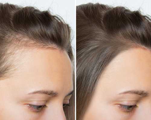 hairline-tattoo-realistic-scalp-coverage-for-thinning-hair