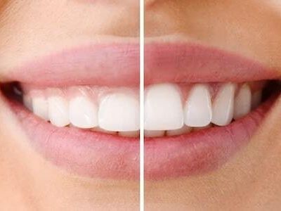 laser-gum-disease-treatment-colorado-dental-wellness-center