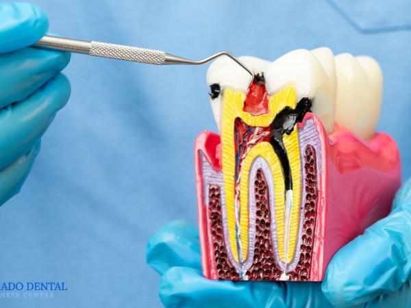 gentle-laser-root-canals-for-faster-comfortable-relief-big-0