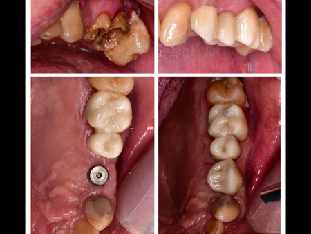 top-dental-implants-in-montebello-vistasol-dental