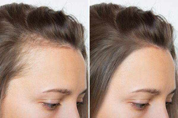 scalp-tattoo-near-vancouver-professional-scalp-micropigmentation-services-big-0