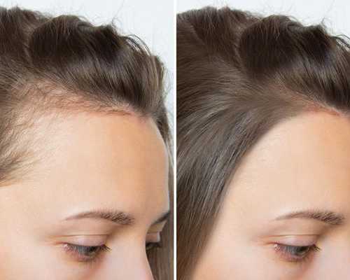 scalp-tattoo-near-vancouver-professional-scalp-micropigmentation-services