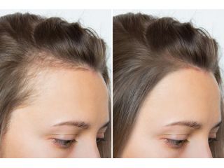 scalp-tattoo-near-vancouver-professional-scalp-micropigmentation-services-small-0