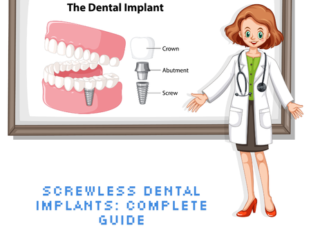 screwless-dental-implants-complete-guide