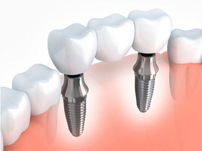 dentures-implants-for-restoration-big-1