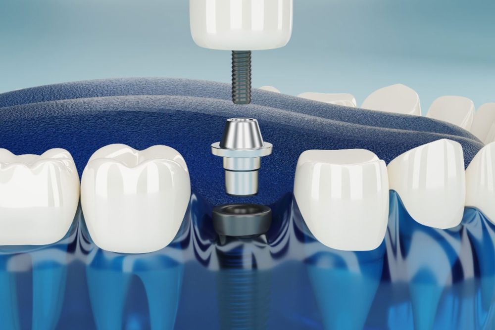 dentures-implants-recovery-what-to-expect-after-implant-replacement-big-1