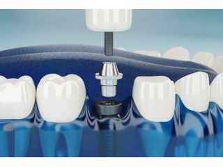 dentures-implants-recovery-what-to-expect-after-implant-replacement-small-1