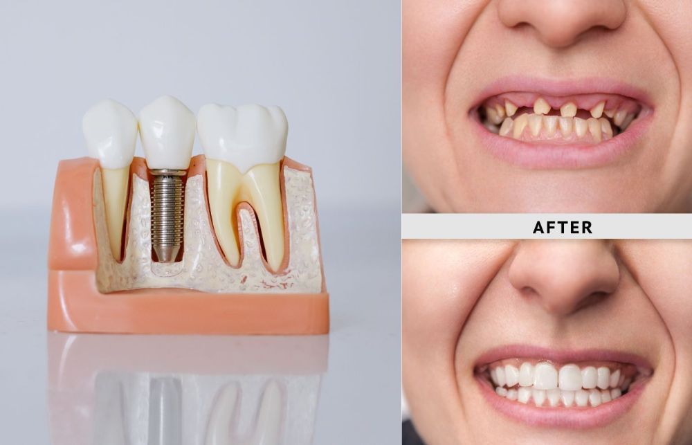 how-long-do-dentures-implants-last-big-1