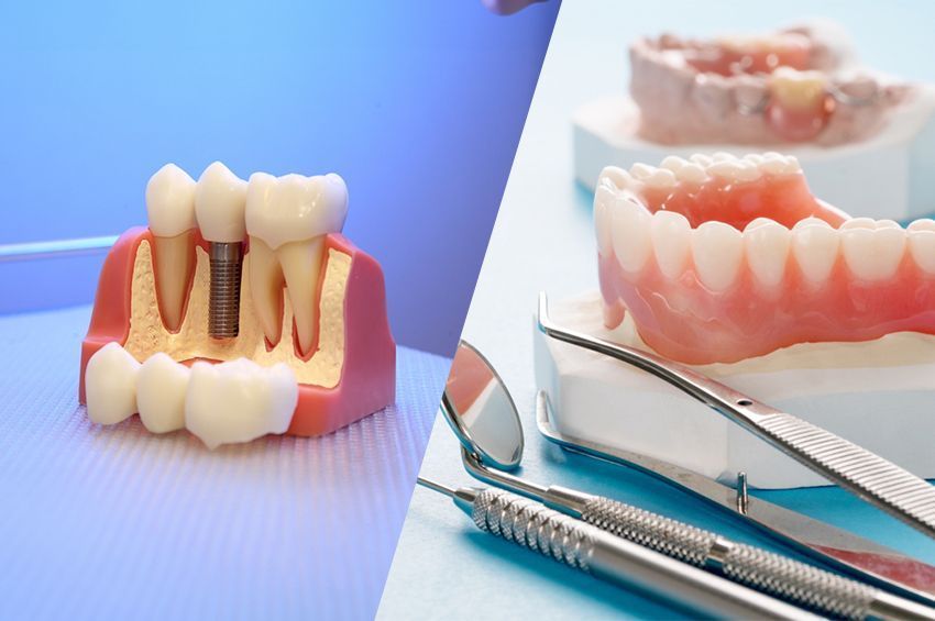 how-long-do-dentures-implants-last-big-2