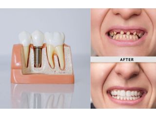how-long-do-dentures-implants-last-small-1