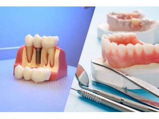 how-long-do-dentures-implants-last-small-2