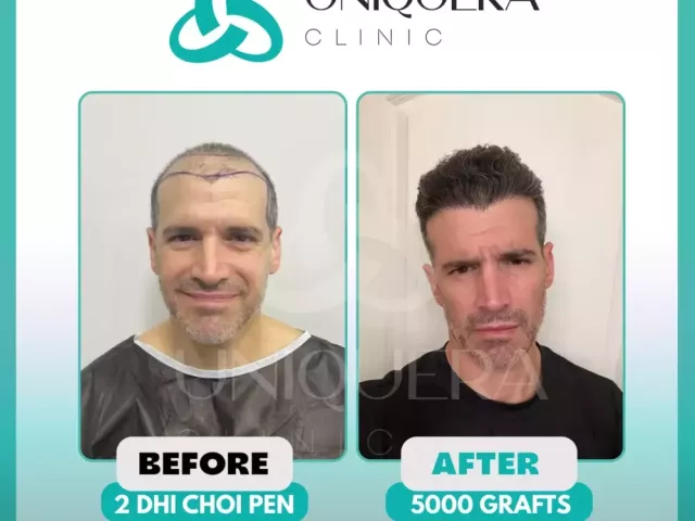 top-10-best-afro-hair-transplant-clinics-around-the-world