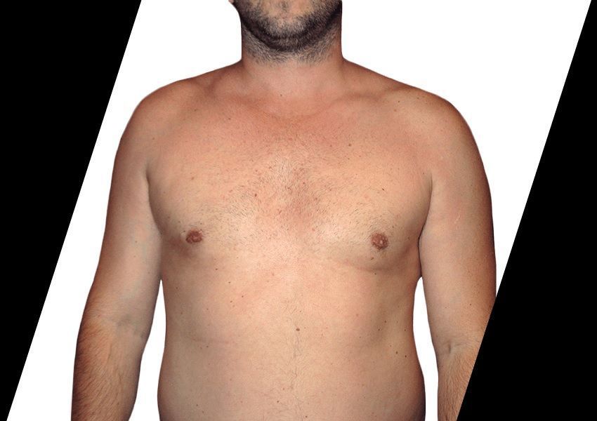 who-is-a-good-candidate-for-abdominal-etching-in-houston-tx-big-0