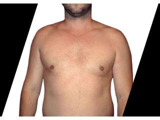 who-is-a-good-candidate-for-abdominal-etching-in-houston-tx-small-0
