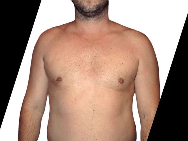 who-is-a-good-candidate-for-abdominal-etching-in-houston-tx