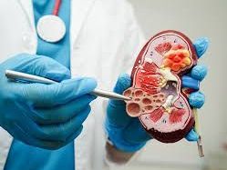 kidney-stone-treatment-laguna-hills-california