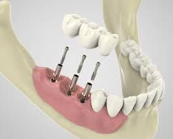 dental-implants-smile-makeovers-services-in-pearland-texas-big-0