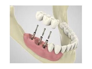 dental-implants-smile-makeovers-services-in-pearland-texas-small-0