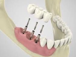 dental-implants-smile-makeovers-services-in-pearland-texas