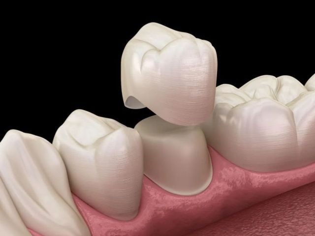 restore-your-smile-with-dental-crowns-in-flagstaff-az