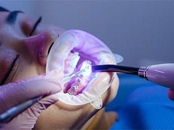 how-does-a-palate-expander-work-in-children
