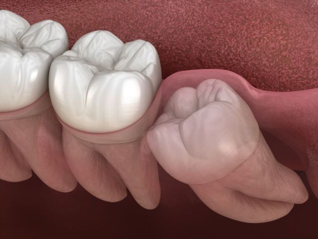 safe-and-gentle-wisdom-teeth-removal-in-paradise-valley-az