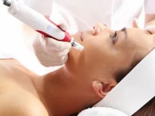 microneedling-treatment-palm-beach-la-vie-spa-gardens-small-0