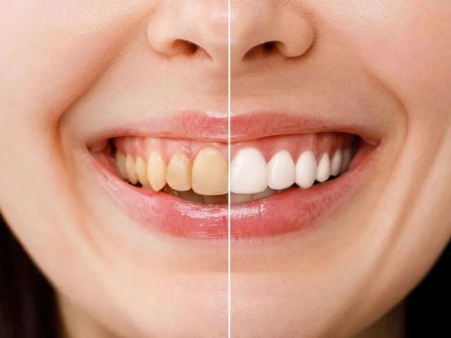 professional-teeth-whitening-in-lake-havasu-city-az