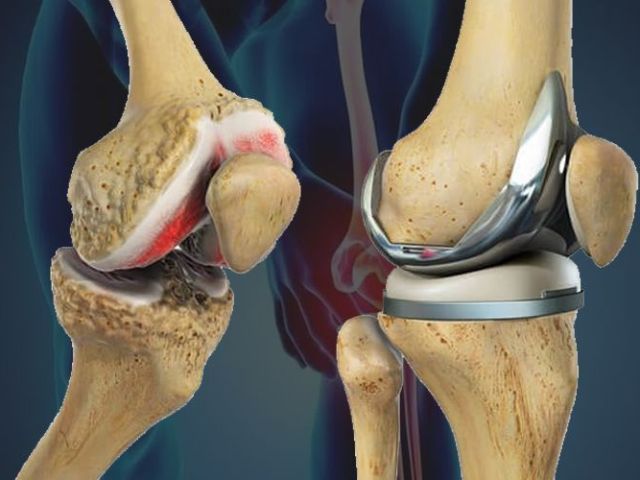 which-hospital-provides-you-the-best-knee-replacement-surgery
