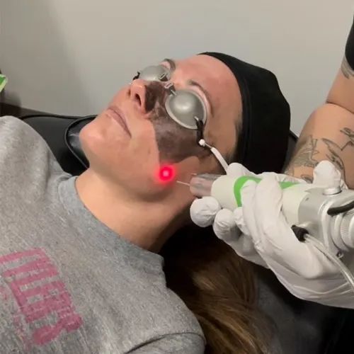 affordable-laser-tattoo-removal-price-in-mckinney-big-0