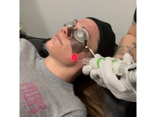 affordable-laser-tattoo-removal-price-in-mckinney-small-0