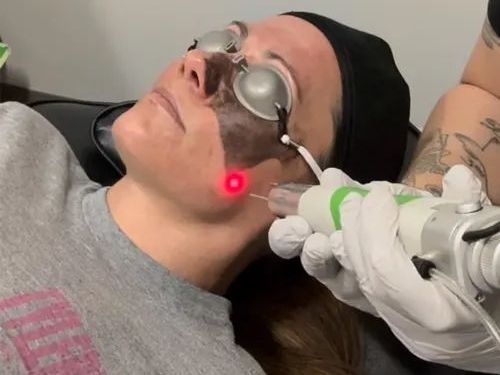 affordable-laser-tattoo-removal-price-in-mckinney