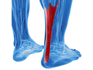 achilles-tendonitis-treatment-houston-trusted-foot-care-small-0