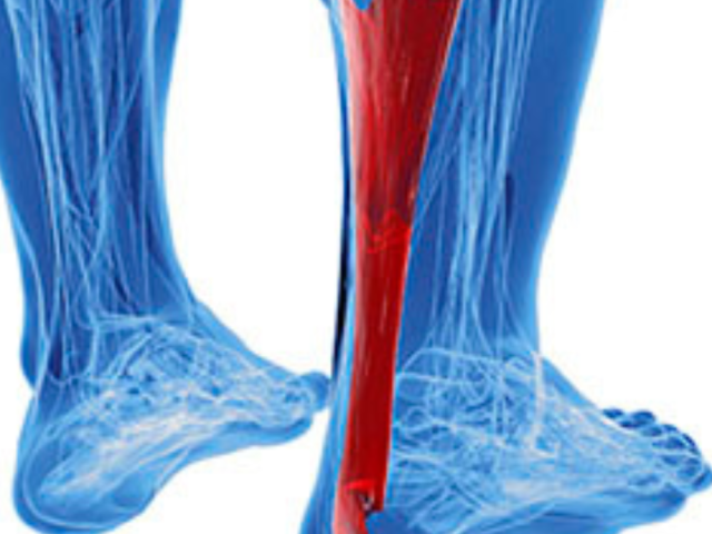 achilles-tendonitis-treatment-houston-trusted-foot-care