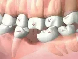 affordable-dental-implants-miami-cost-guide-today