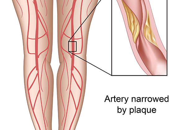 advanced-peripheral-artery-disease-test-for-accurate-diagnosis
