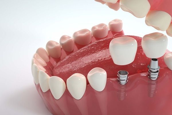dental-implants-northeast-philadelphia-big-0