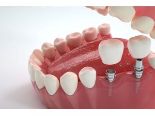 dental-implants-northeast-philadelphia-small-0
