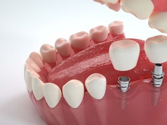 dental-implants-northeast-philadelphia