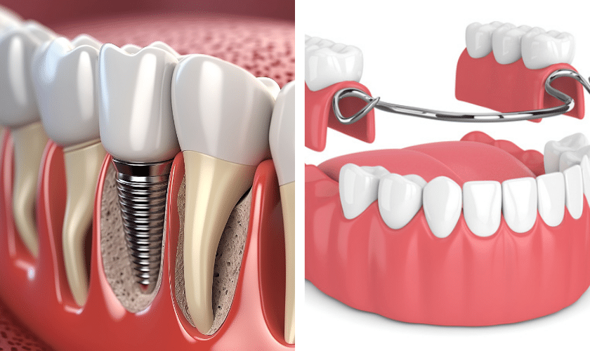 are-dentures-implants-removable-big-1