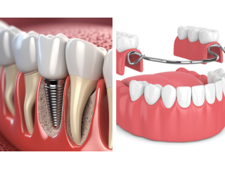 are-dentures-implants-removable-small-1
